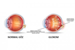 GÖZ TANSİYONU GÖRME KAYBINA NEDEN OLUYOR